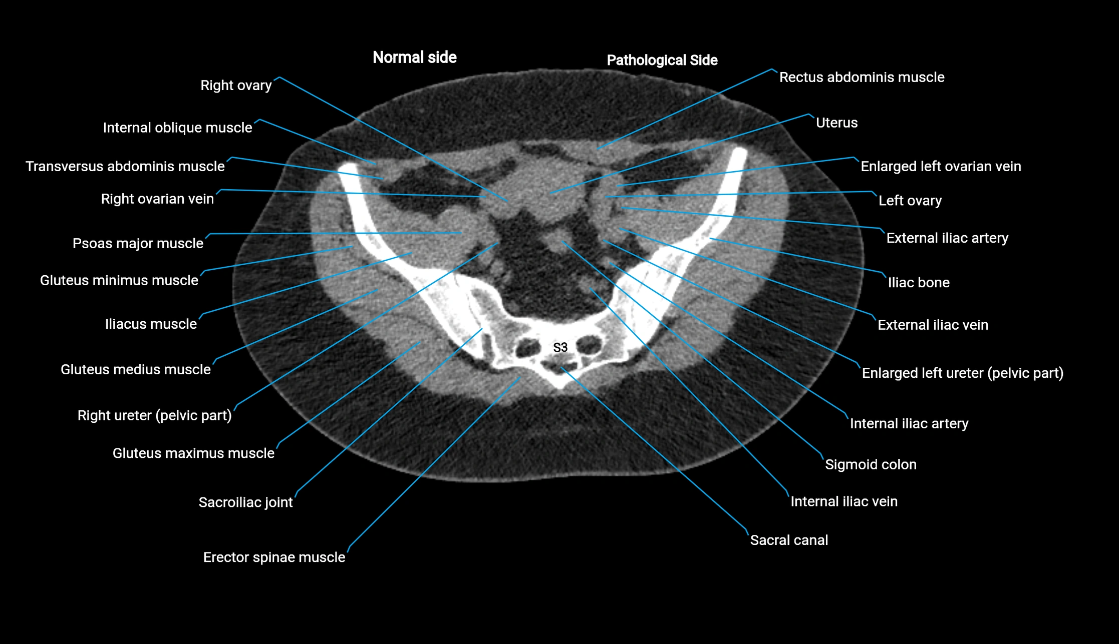 CT KUB axial cross sectional anatomy  radiology image -img-00201-00127.webp